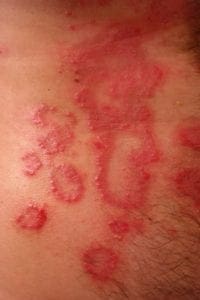 causes of rashes in adults