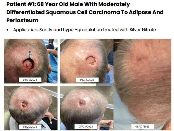 wound-care-1 - Suncoast Skin Solutions