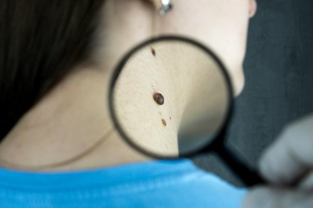 skin cancer - Suncoast Skin Solutions Skin Cancer Risk Factors