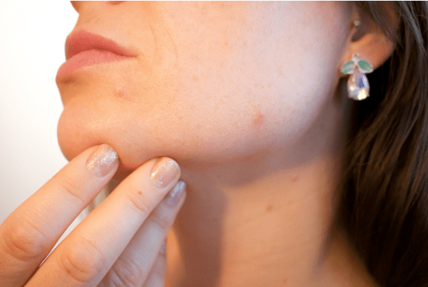 fungal skin infections - Suncoast Skin Solutions Fungal infection
