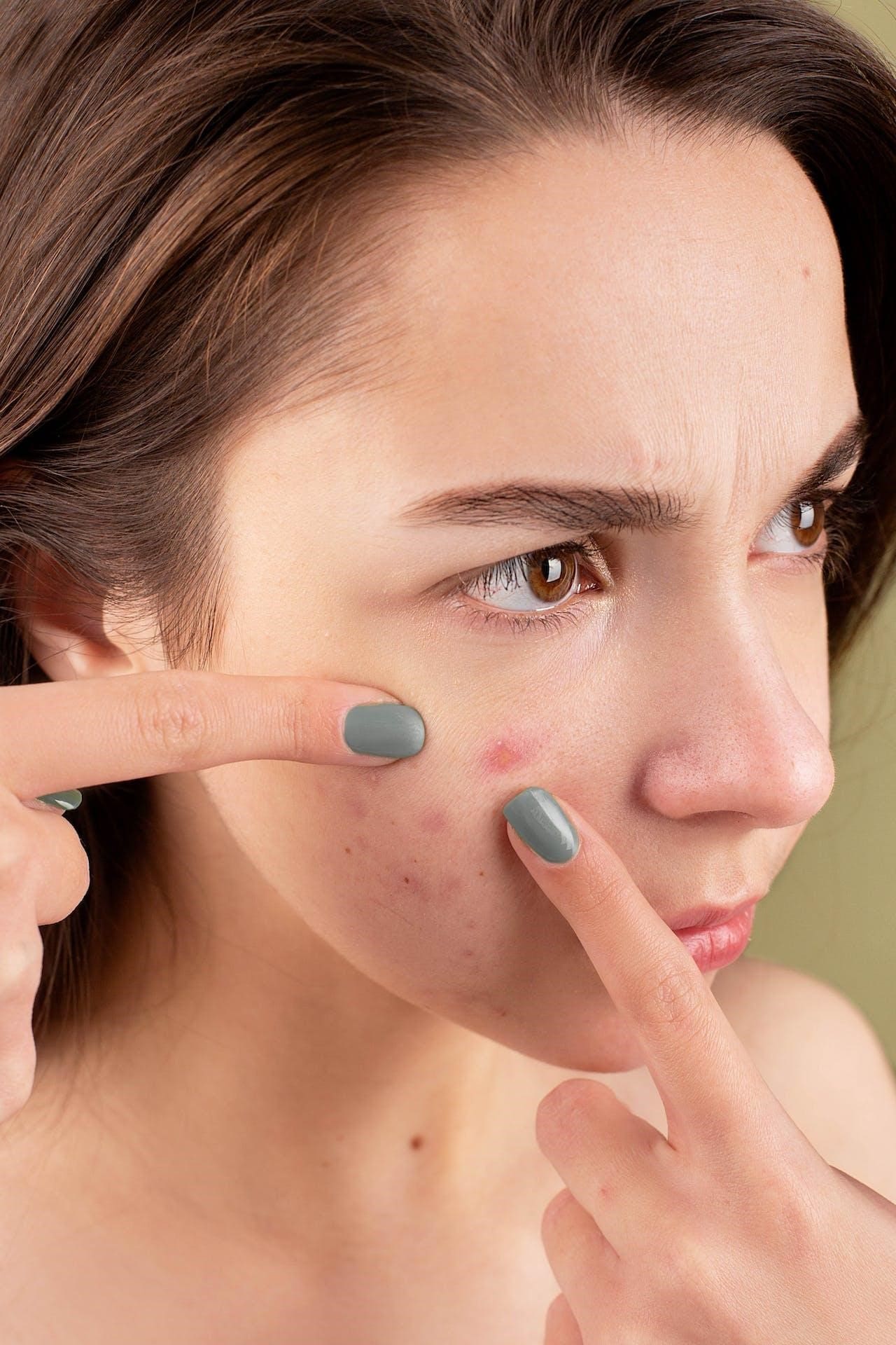 pimples - Suncoast Skin Solutions Popping a Pimple